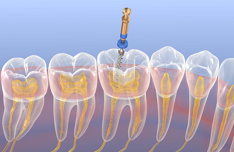 Alldental Behandelingen Endodontologie