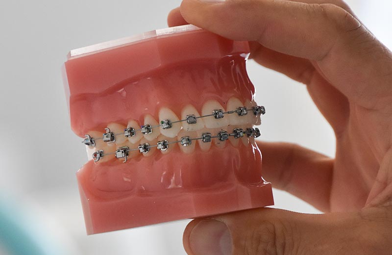 Alldental Behandelingen Orthodontie